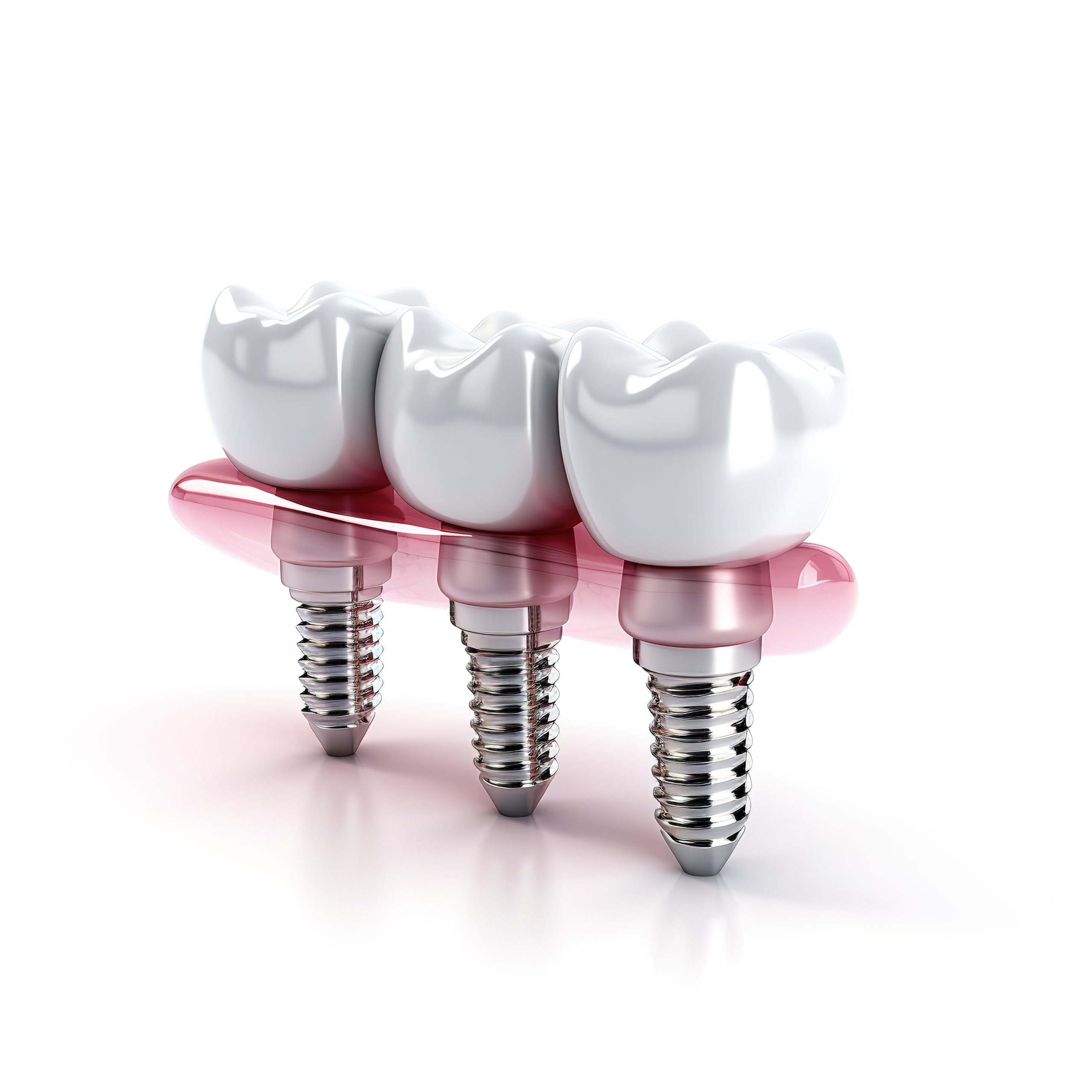 Dental Bridge VS Implant – A Complete Guide