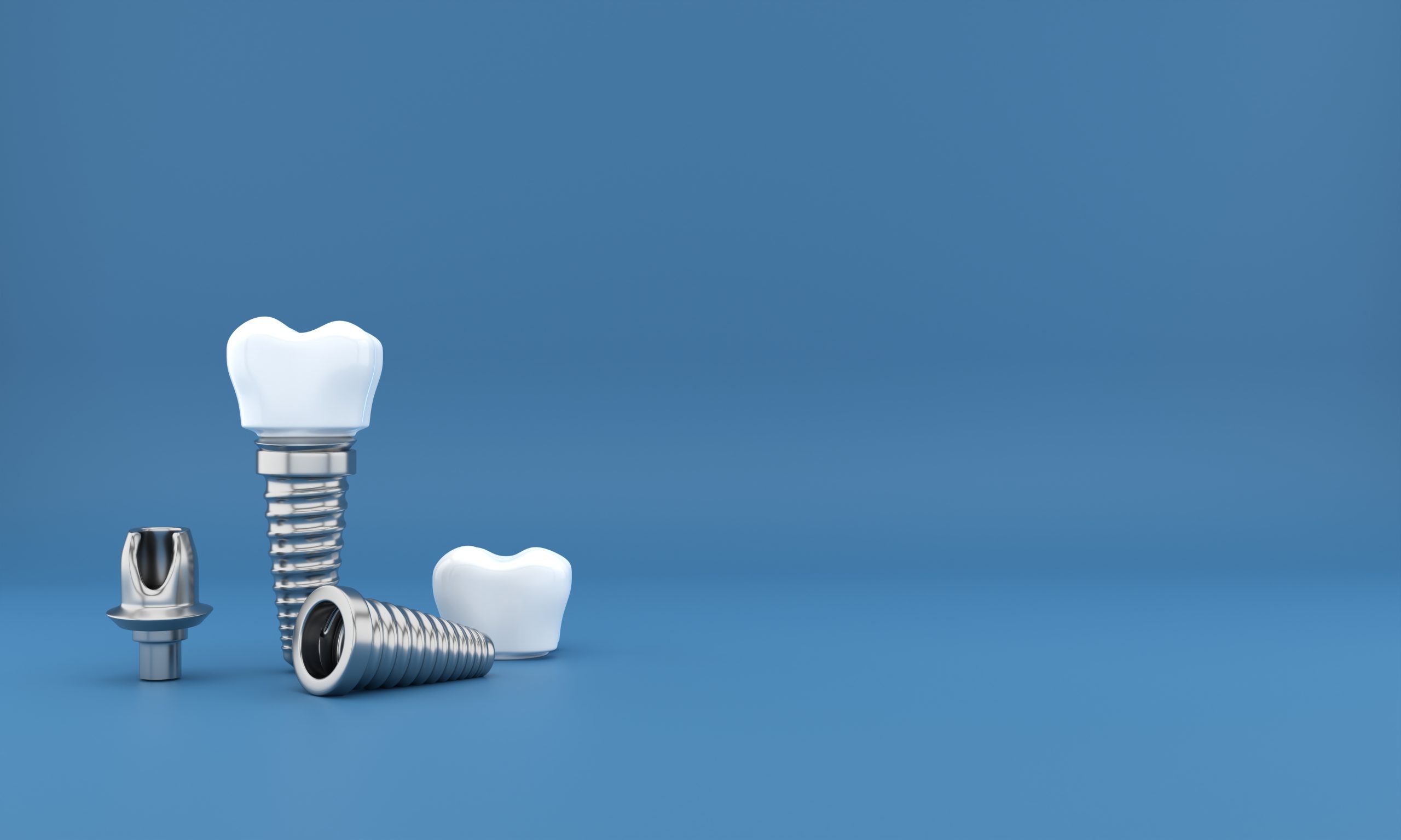 How Much Do Dental Implants Cost? | Best Dental
