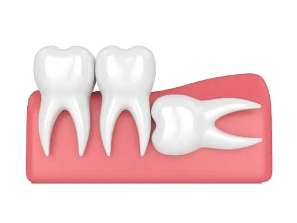 Wisdom Teeth Removal Houston, TX | Best Dental