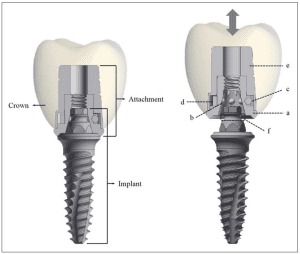 Prosthetic Attachment