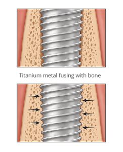 Osseointegration