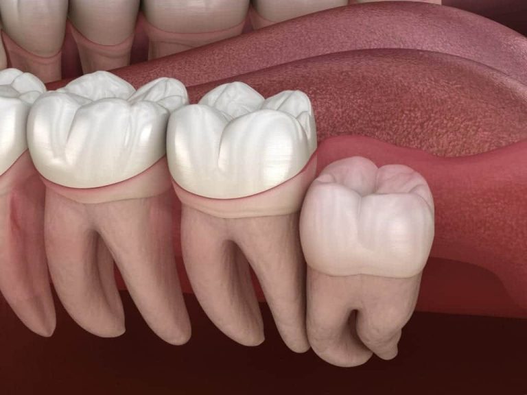 Wisdom Teeth Removal Houston | Best Dental