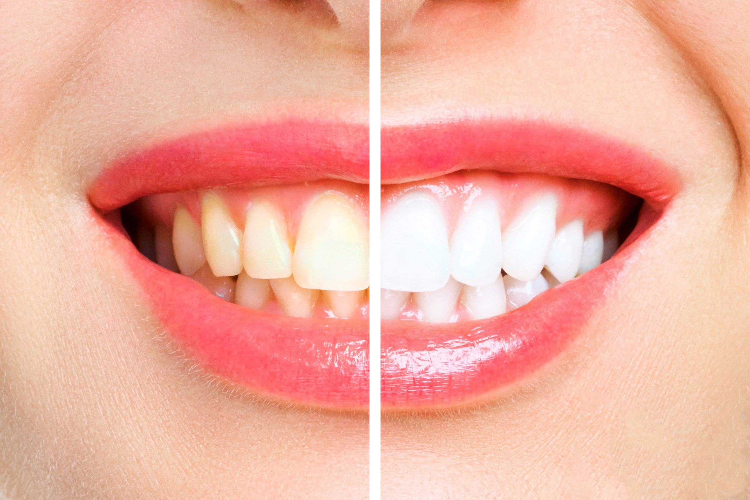 Teeth Whitening Costs | Best Dental