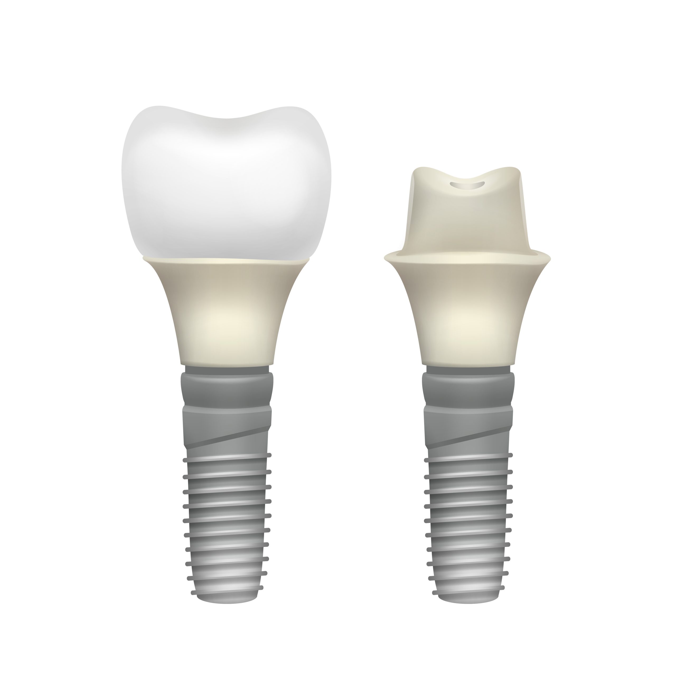 2 Dental Implants Or 4-unit Dental Bridge?