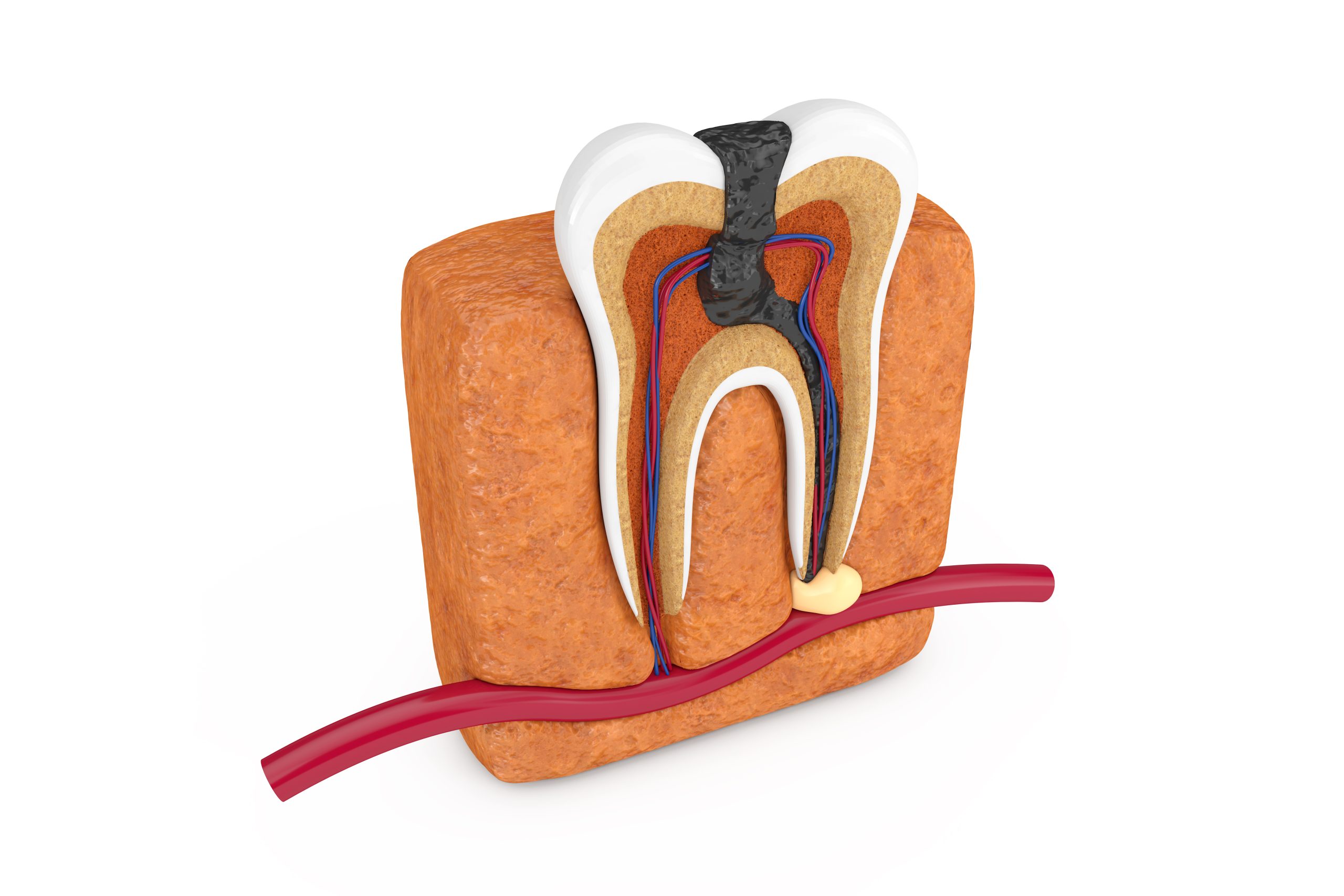 Tooth Extraction Or Root Canal? | Best Dental