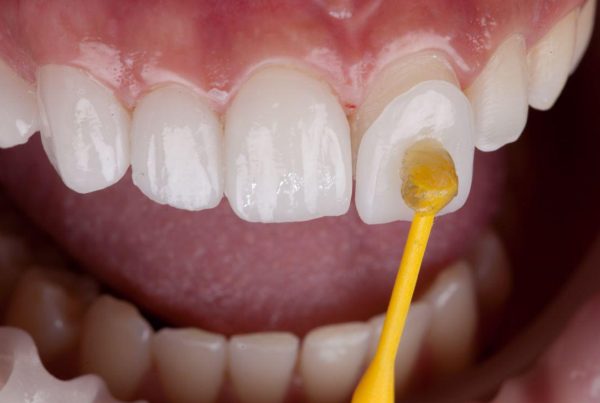 What Does Cosmetic Dentistry Include? | Best Dental