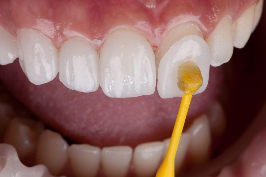 What Does Cosmetic Dentistry Include? | Best Dental