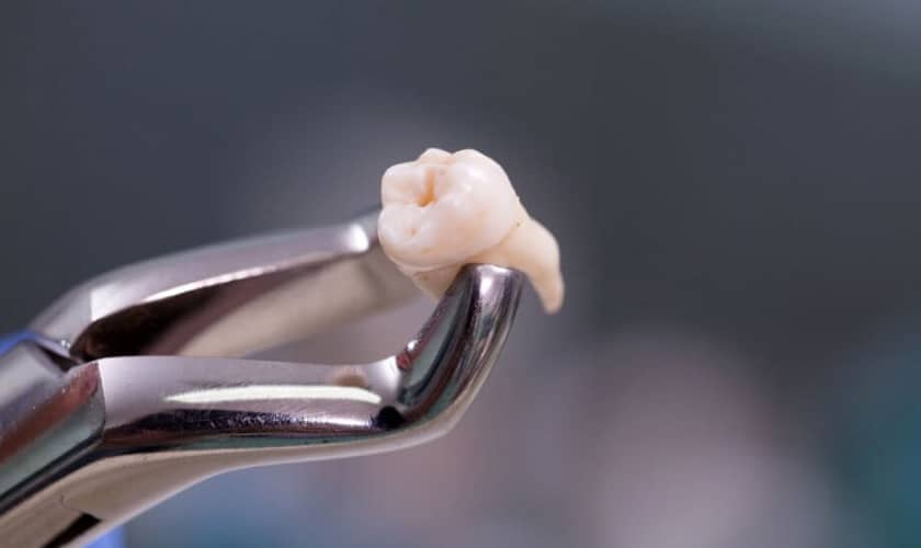 Wisdom Tooth Decay Treatment | Best Dental