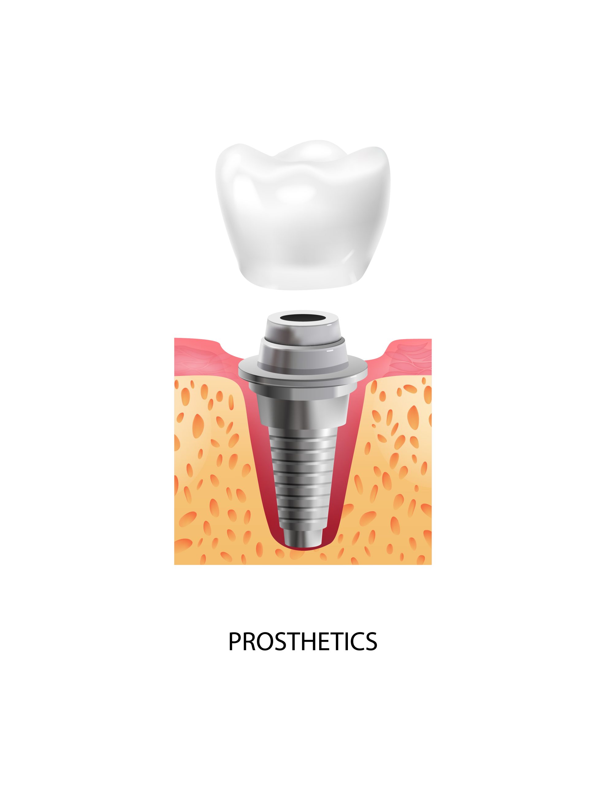 Dental Implants Success Rate | Best Dental