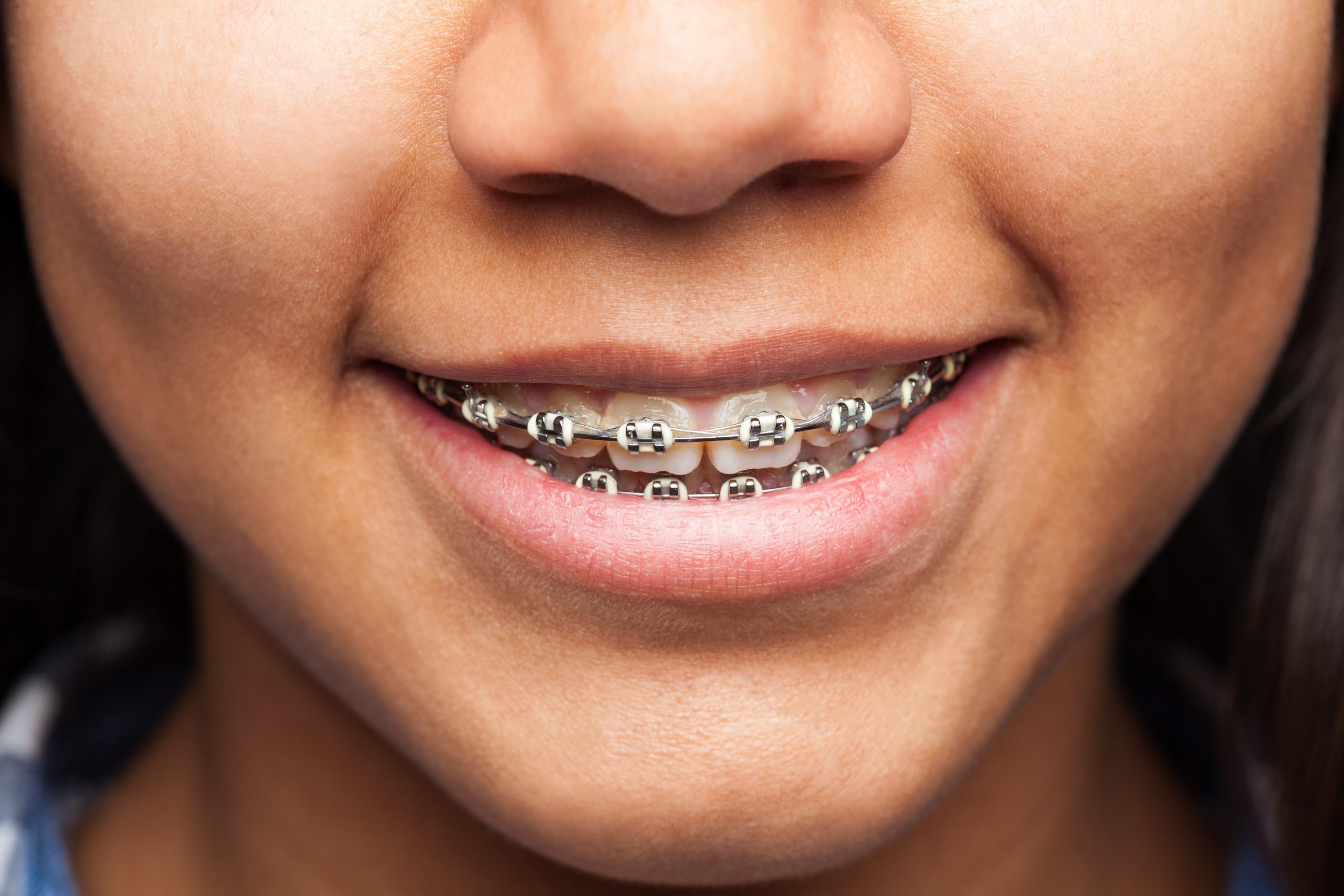 Braces And Wisdom Teeth Removal | Best Dental