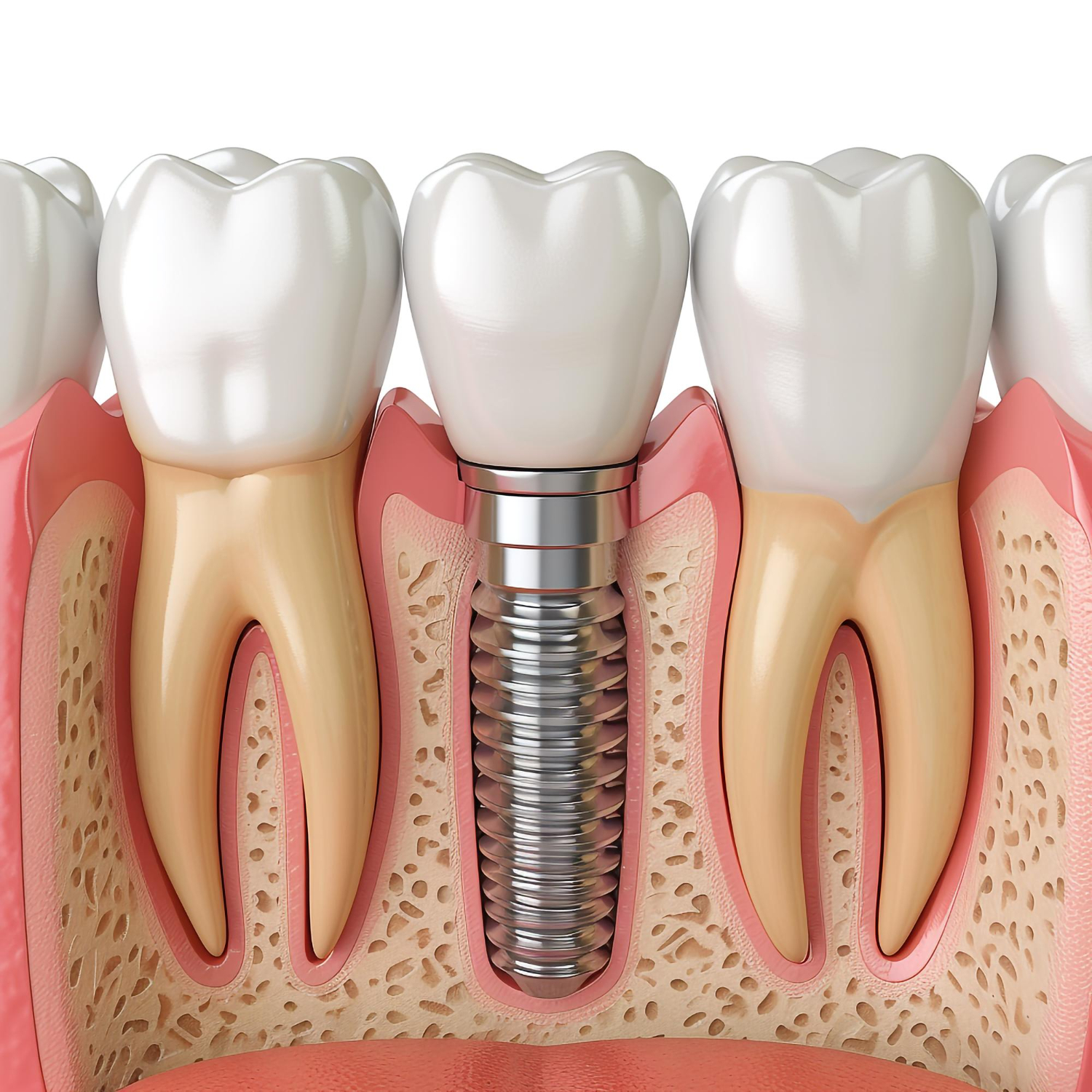 Dental Implants With Teeth Braces | Best Dental