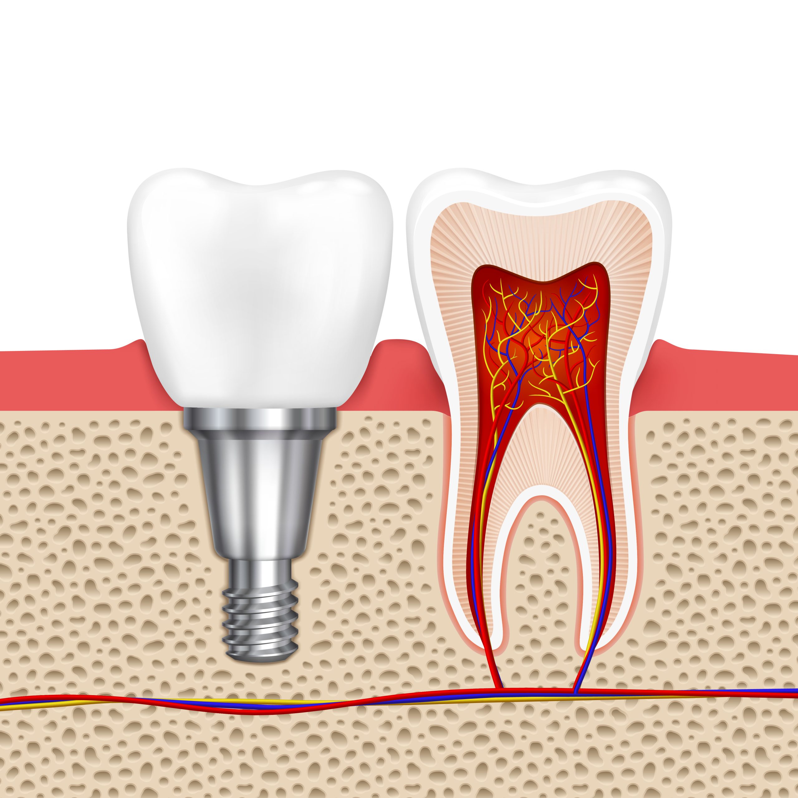 Dental Implants With Teeth Braces | Best Dental