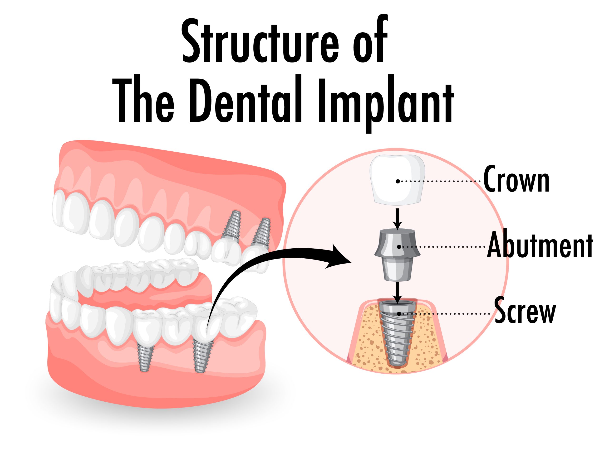 Dental Implants With Teeth Braces | Best Dental