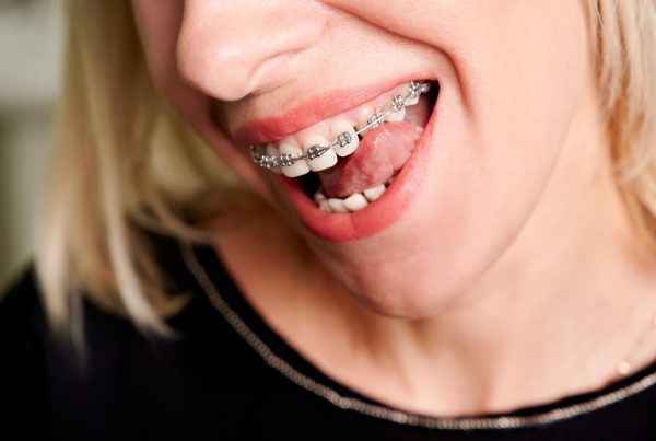 What Is The Best Age To Get Teeth Braces? | Best Dental