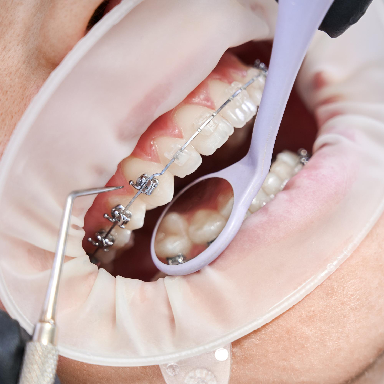 What Is The Best Age To Get Teeth Braces? | Best Dental