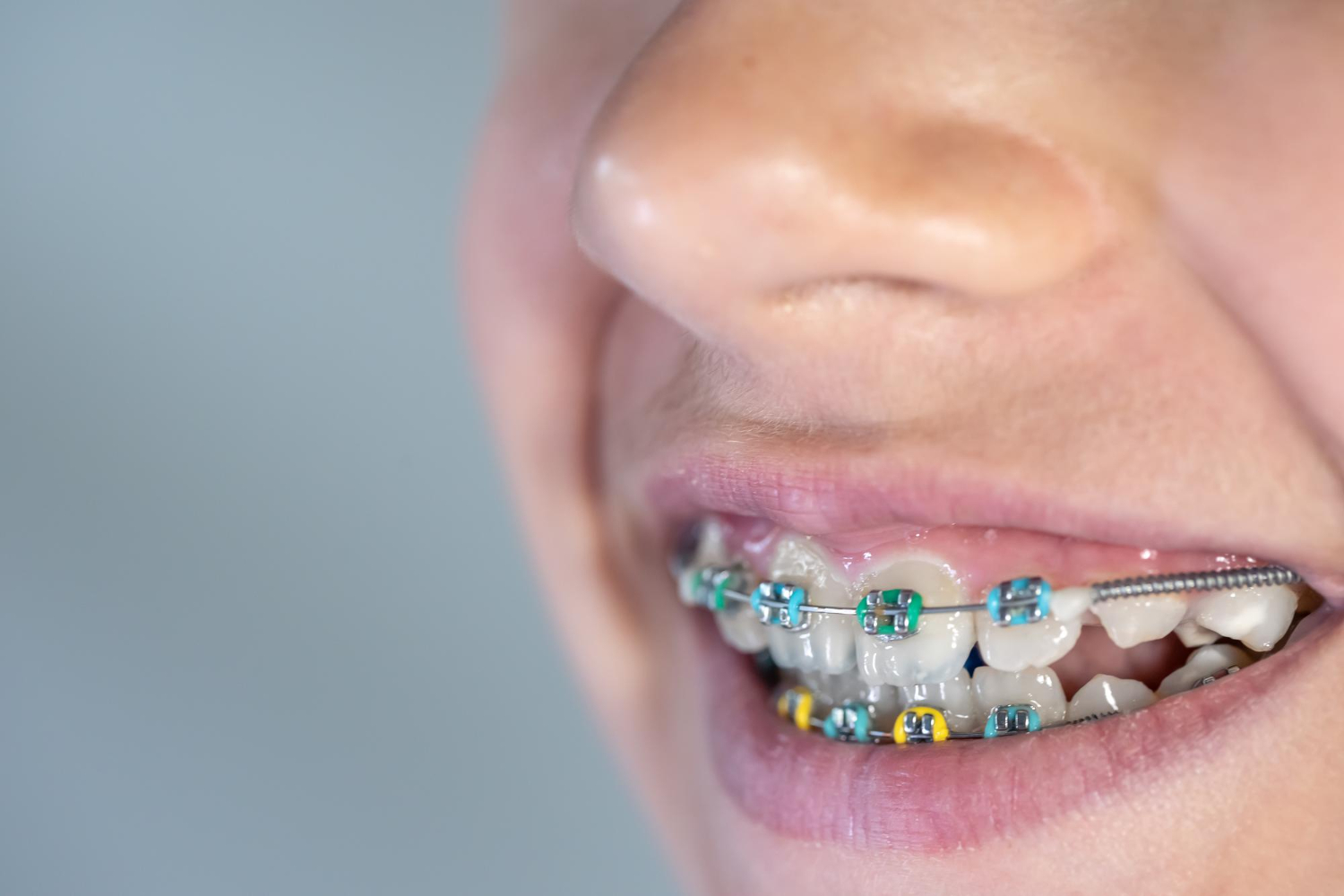 What Is The Best Age To Get Teeth Braces? | Best Dental