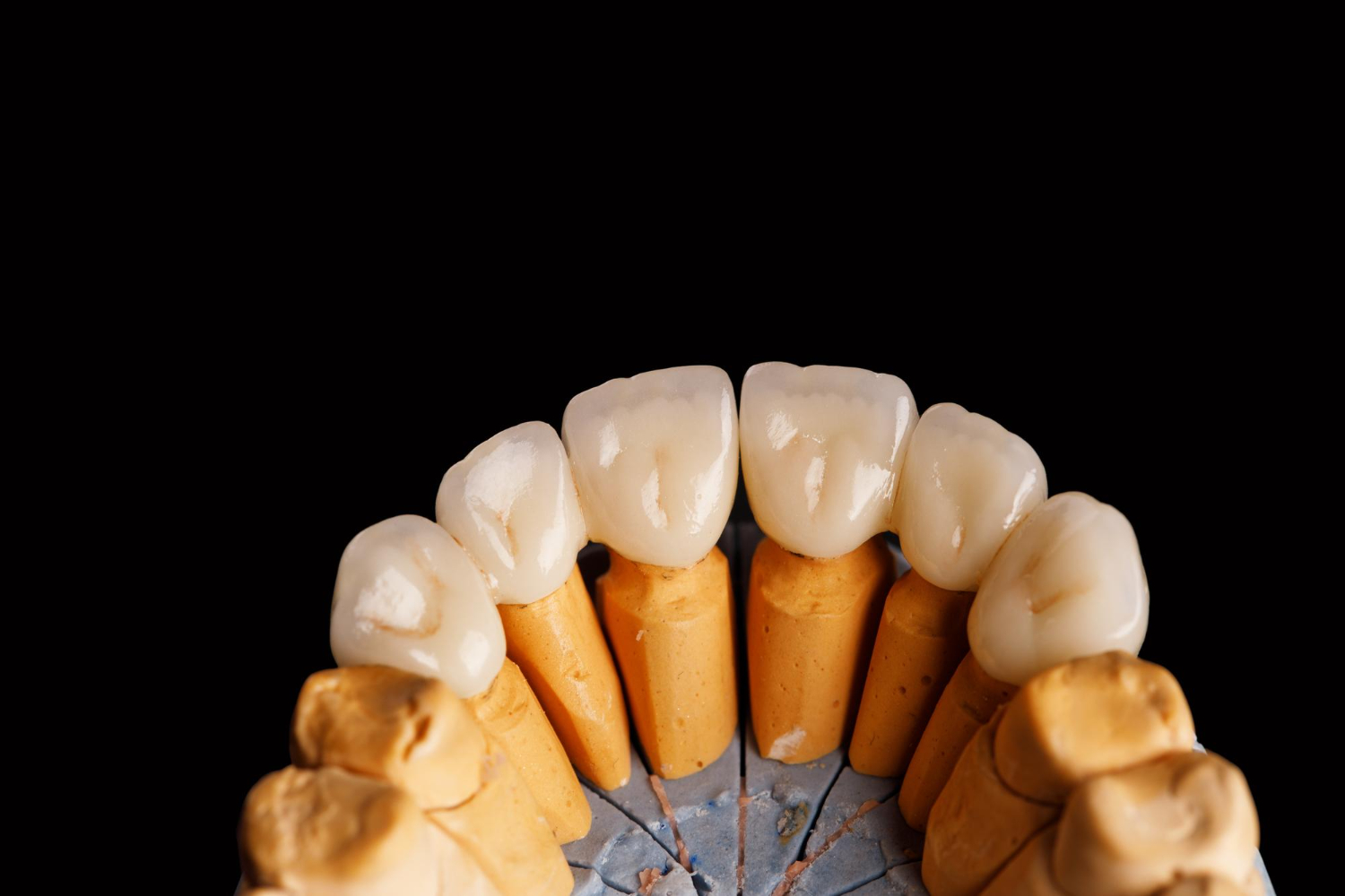 Why Dental Crowns Are Needed