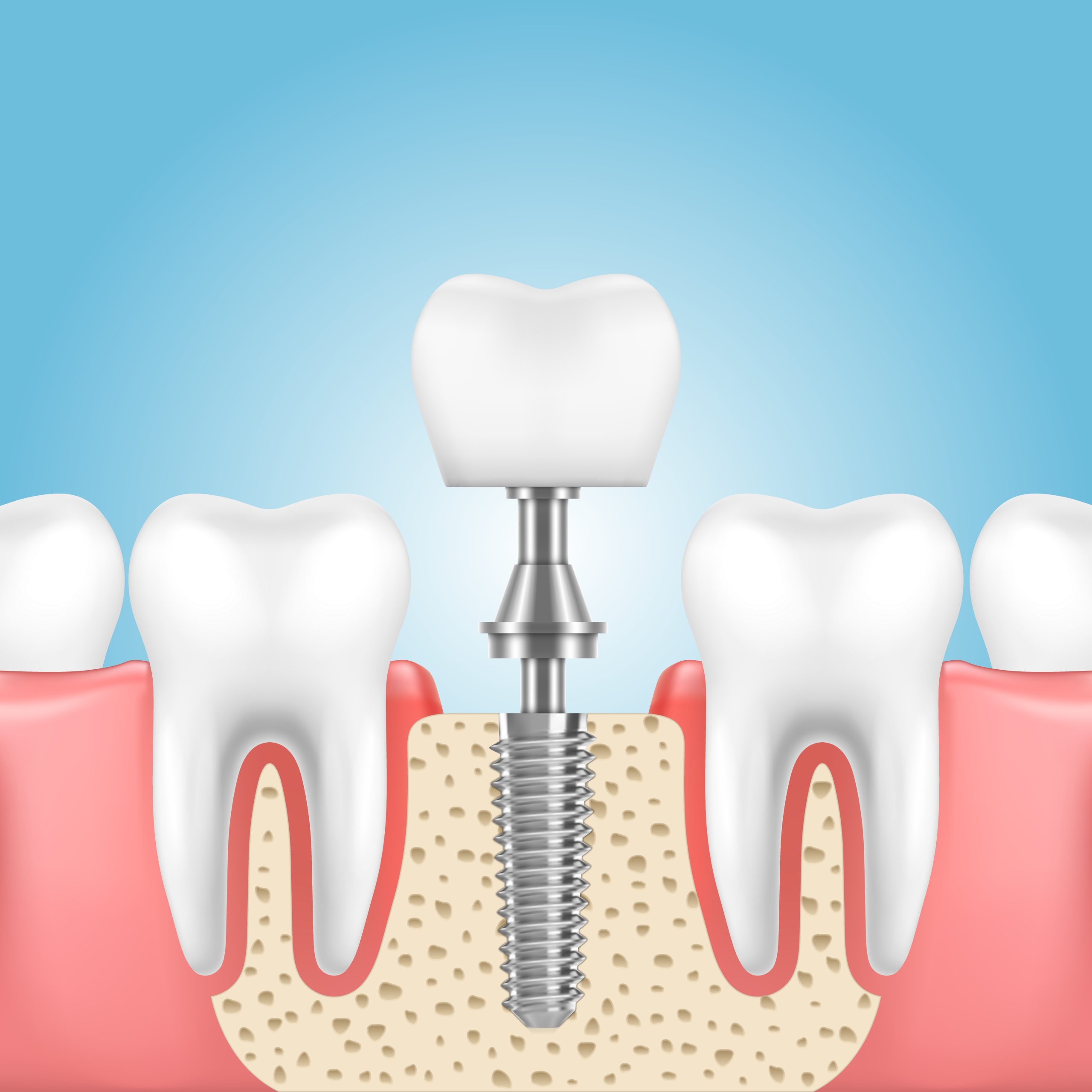 How Smoking Can Affect Dental Implants