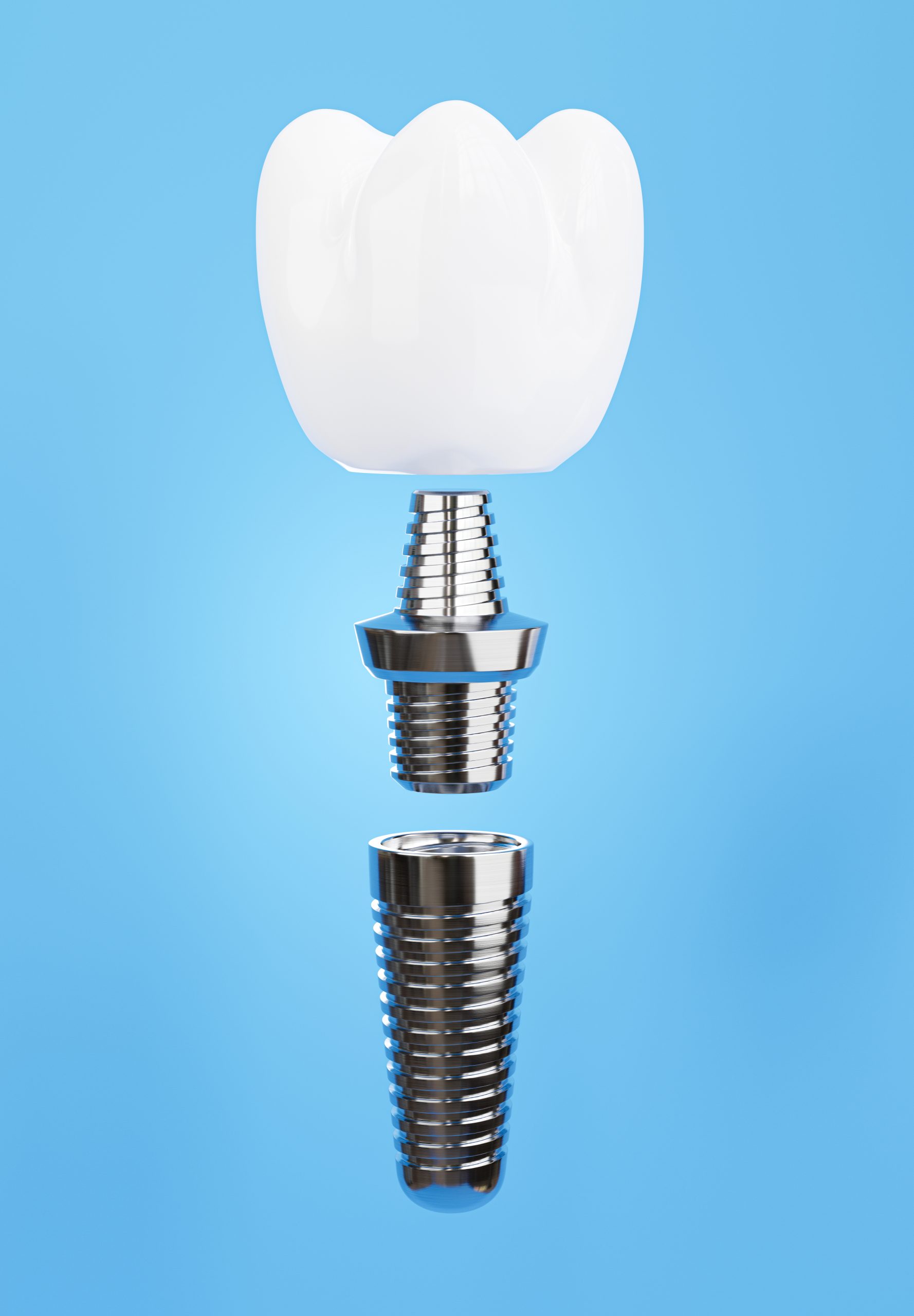 Why Are Dental Implants Expensive?