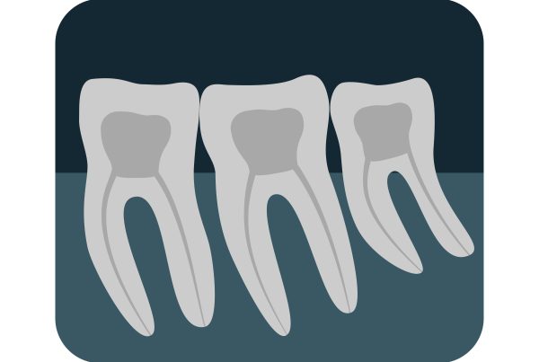 Wisdom Teeth Infection | Best Dental