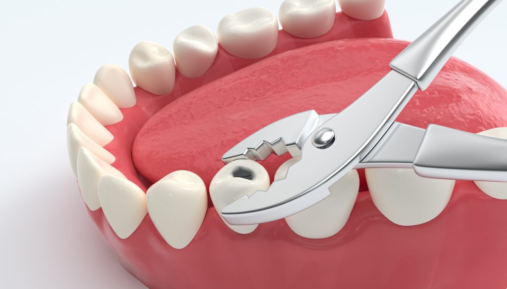 How Painful Is A Tooth Extraction?