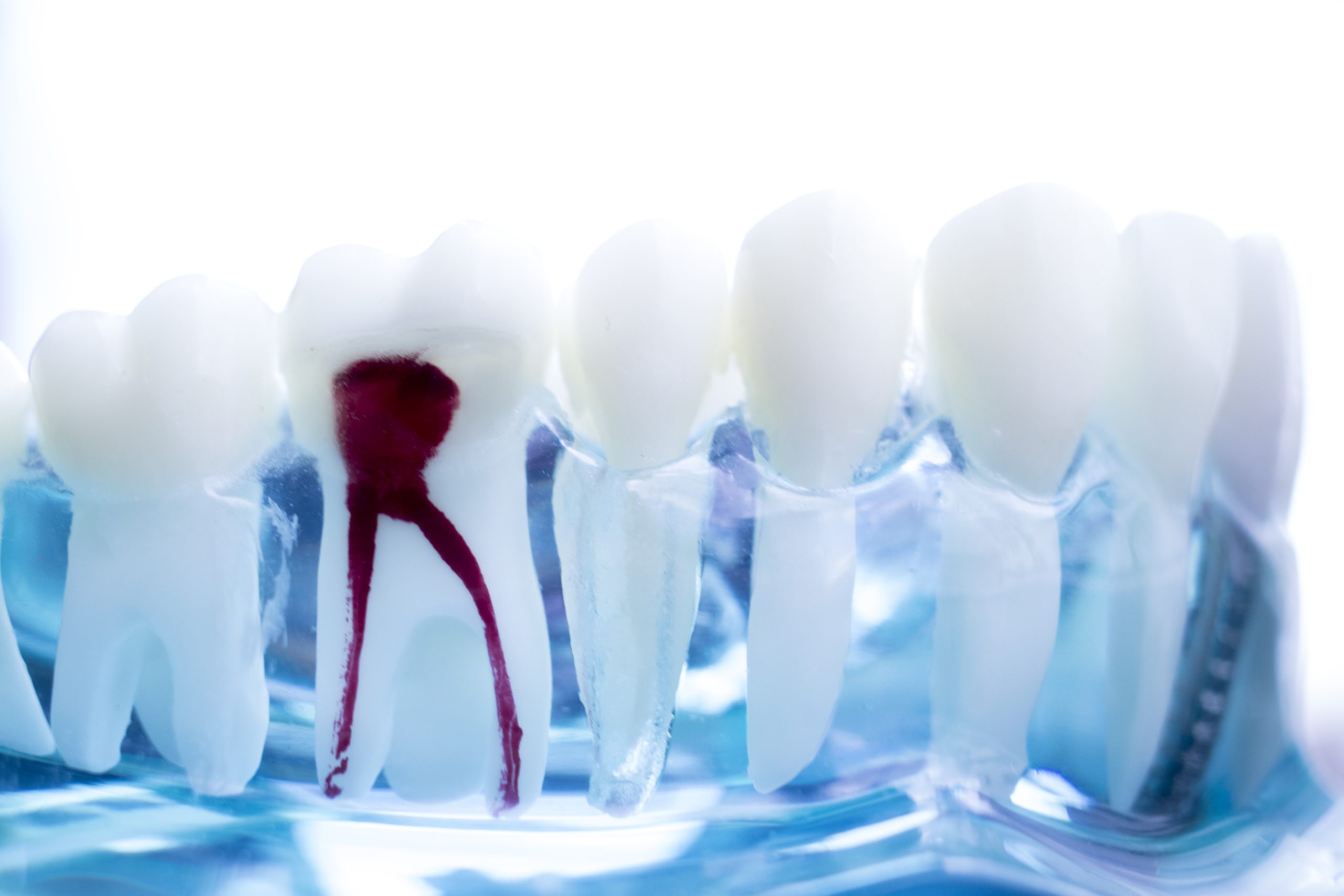 Root Canal on Wisdom Tooth | Best Dental in Houston, TX