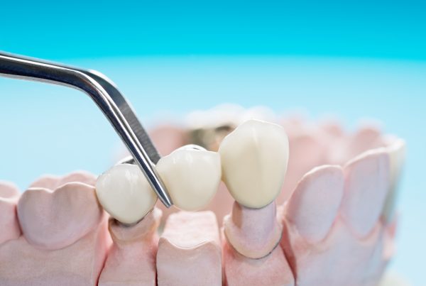 Dental Bridge Treatment | Best Dental