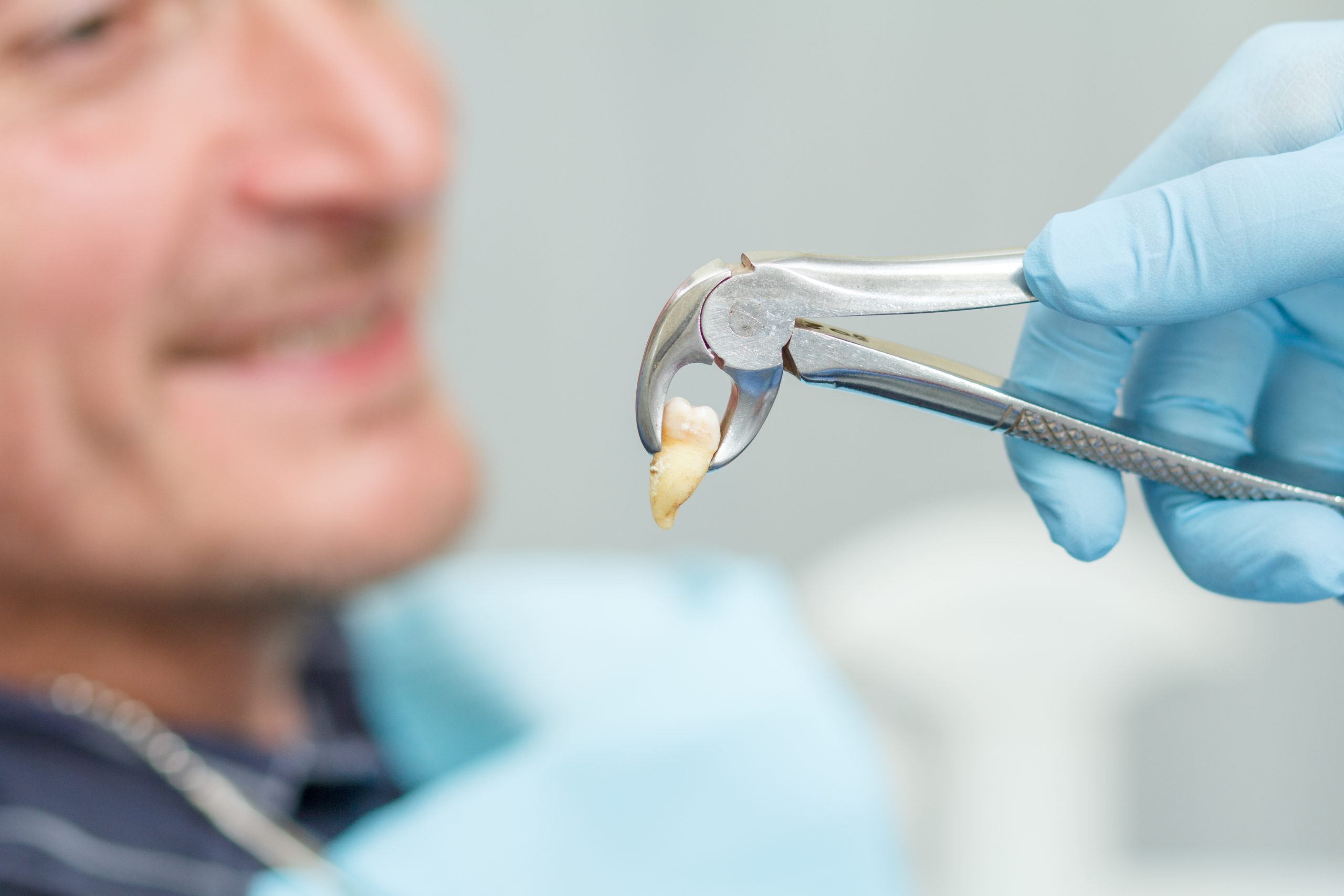 Simple vs. Surgical Tooth Extraction | Best Dental