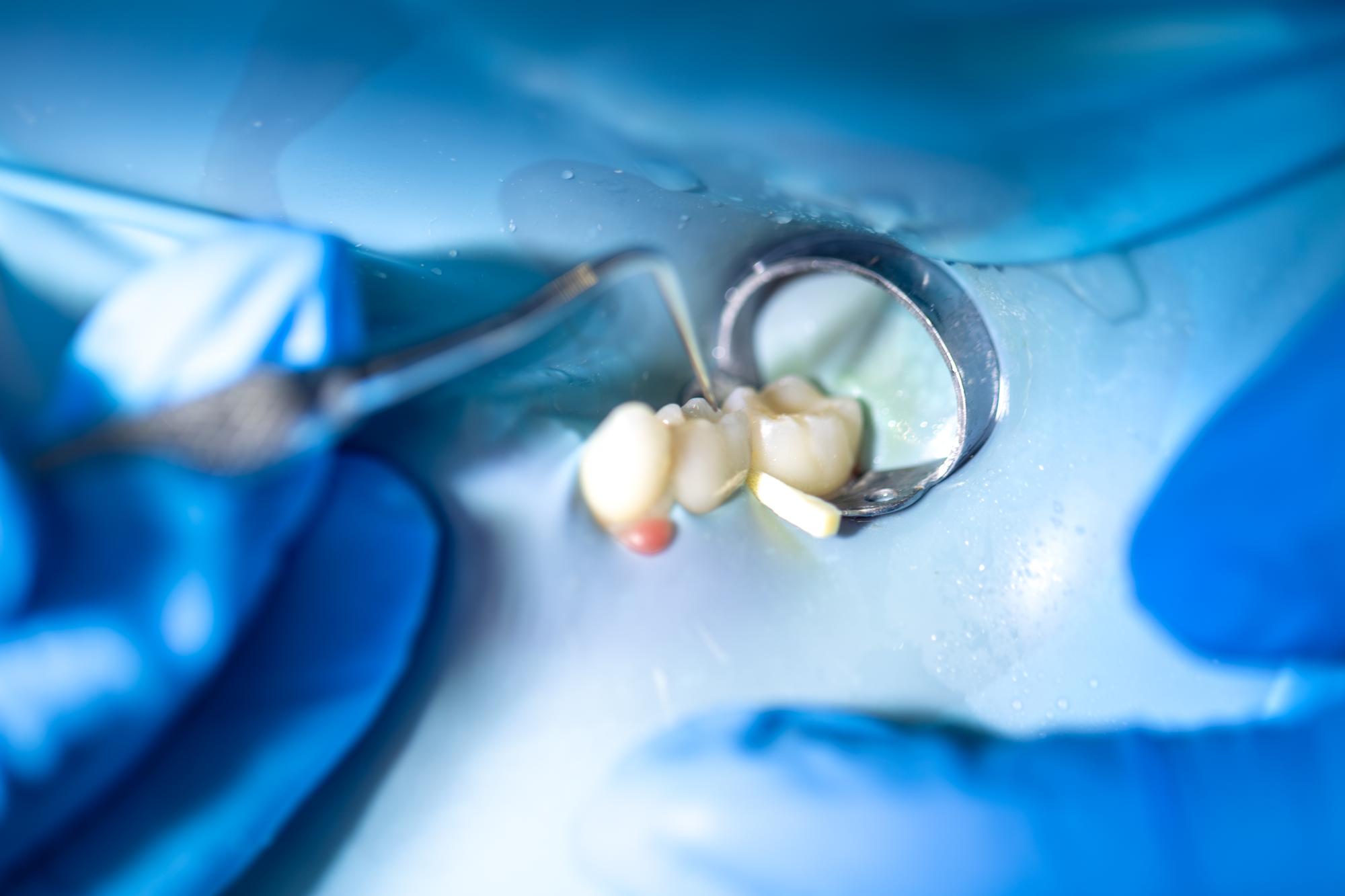 Root Canal on Wisdom Tooth | Best Dental in Houston, TX