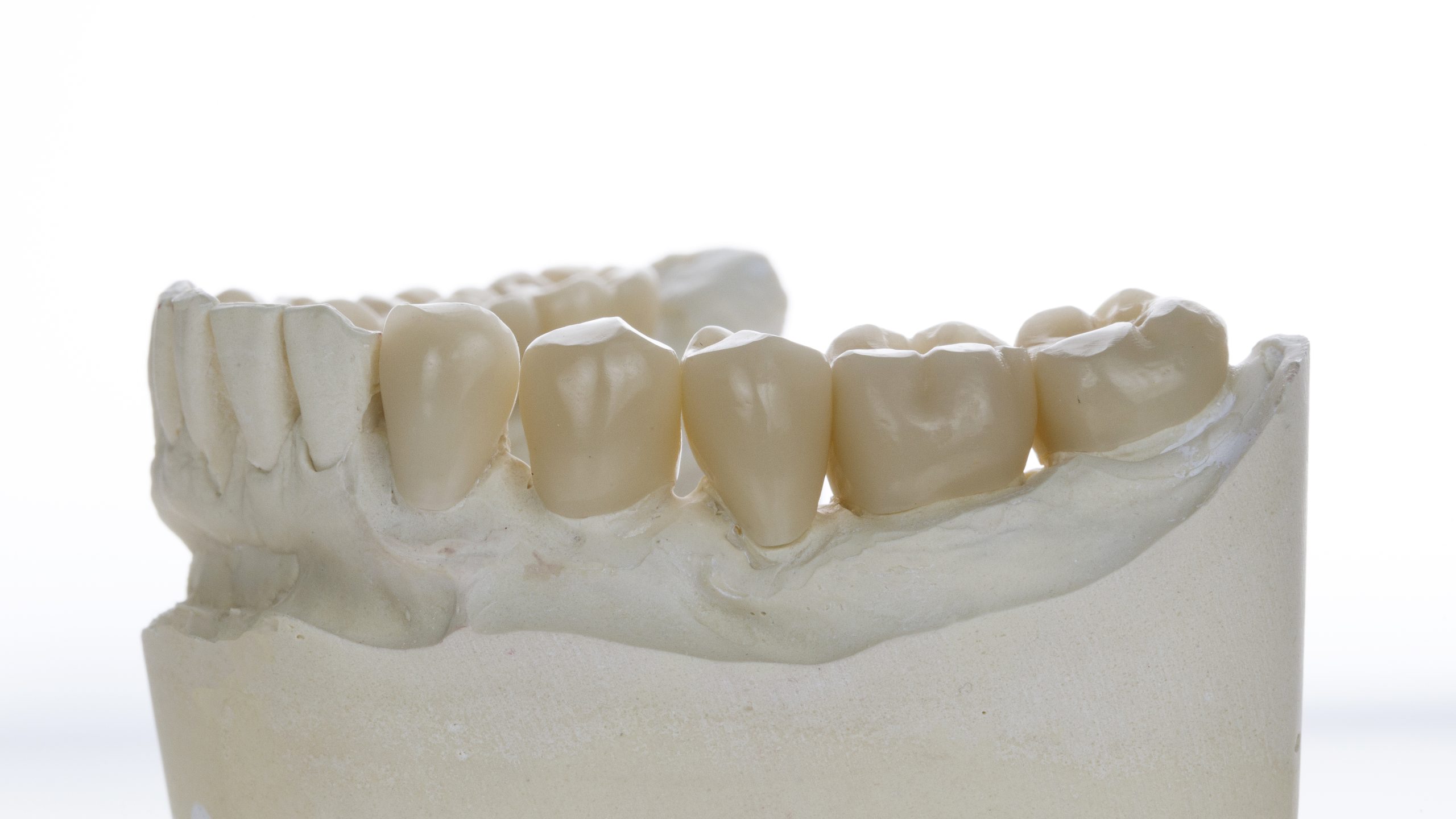 Dental Bridge Treatment | Best Dental