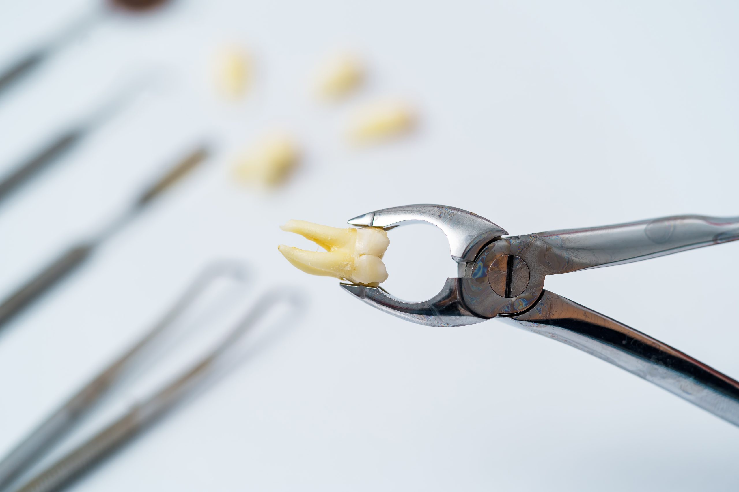 Simple vs. Surgical Tooth Extraction | Best Dental