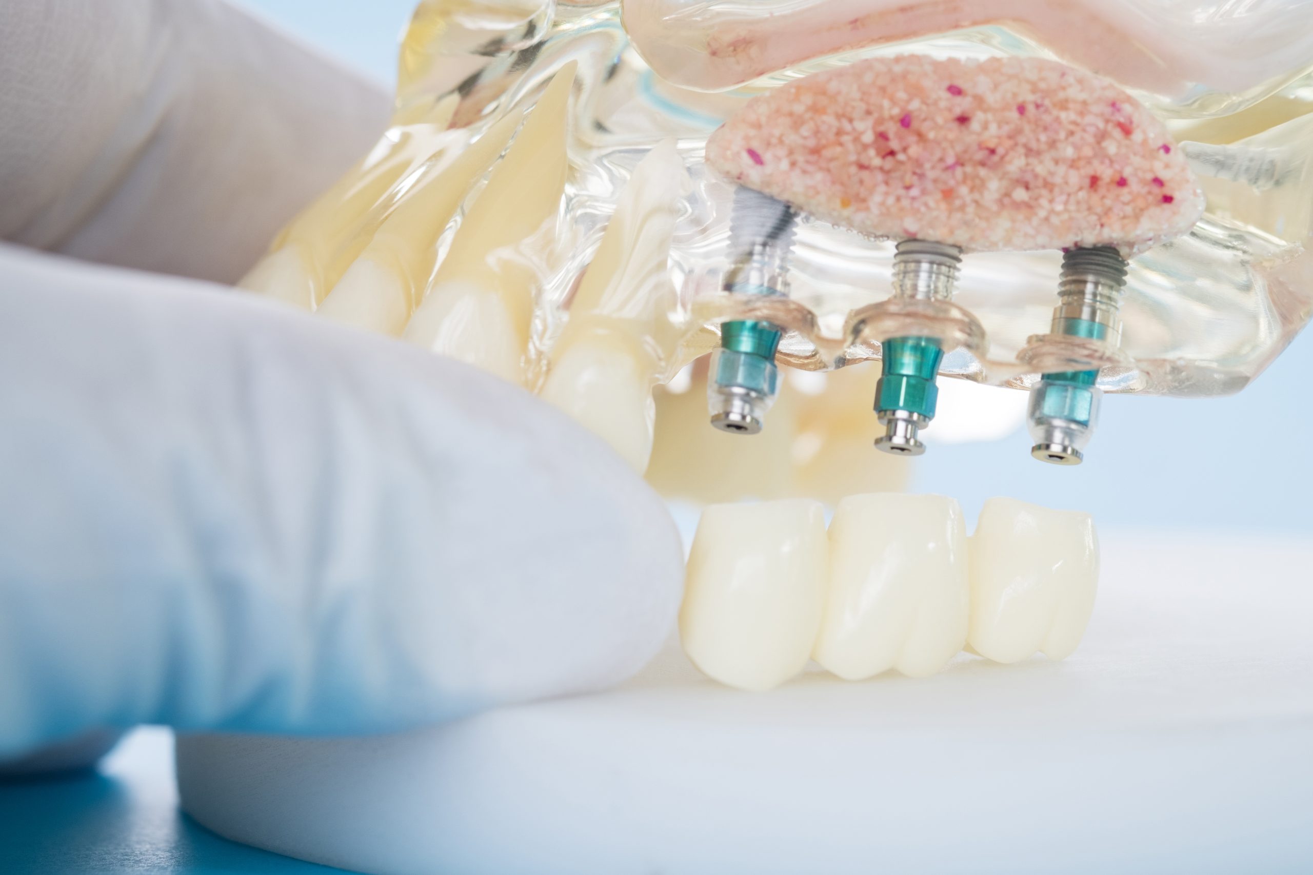 Managing After Dental Implant Surgery | Best Dental In Houston