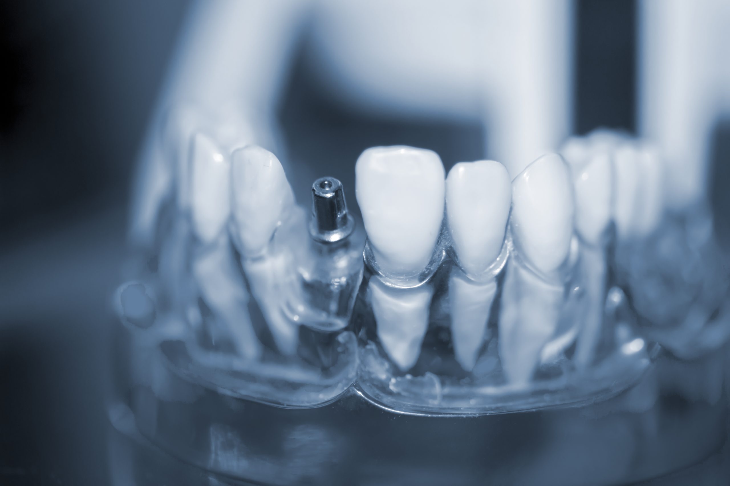 Managing After Dental Implant Surgery | Best Dental In Houston
