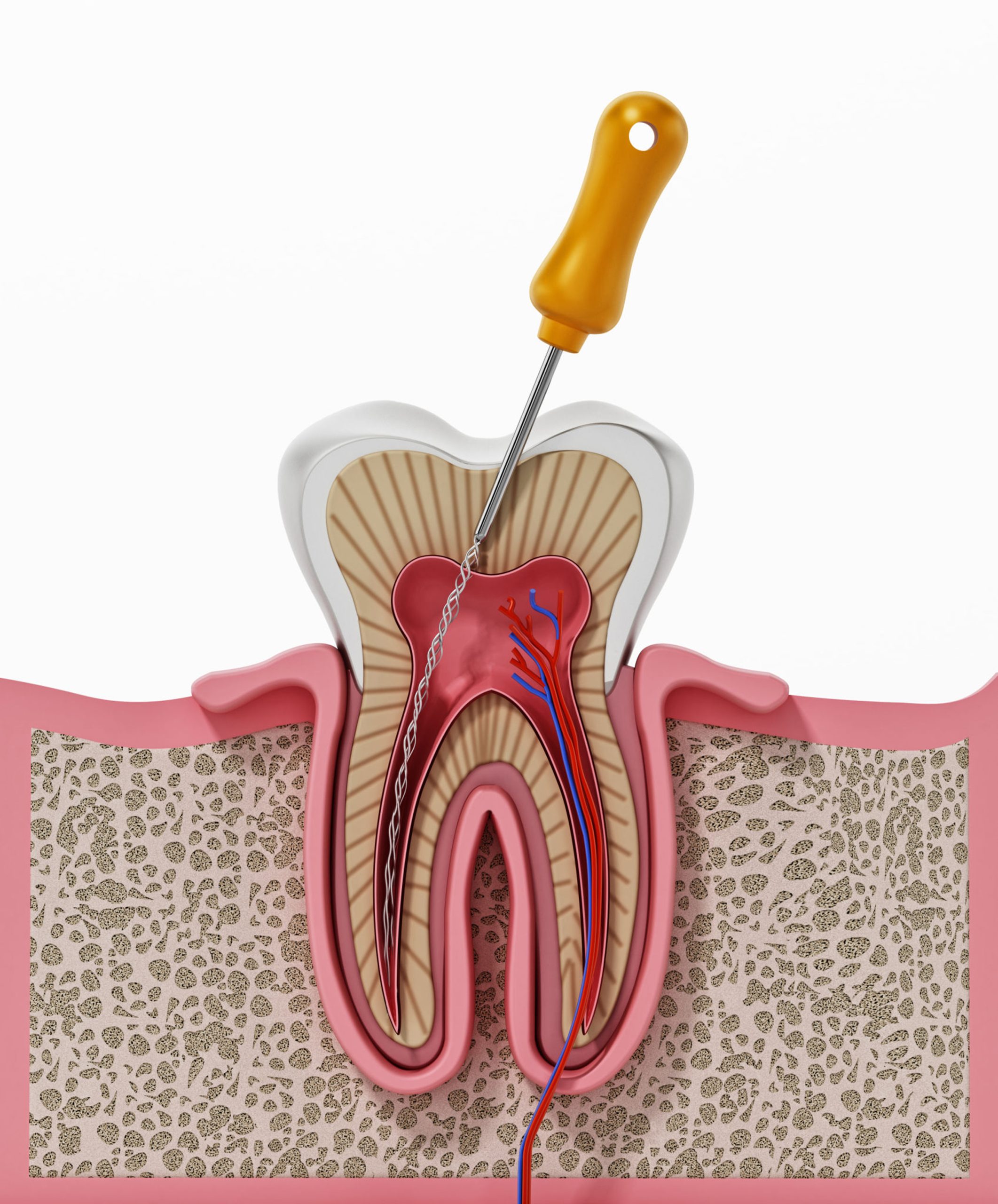 Reducing Root Canal Costs | Best Dental