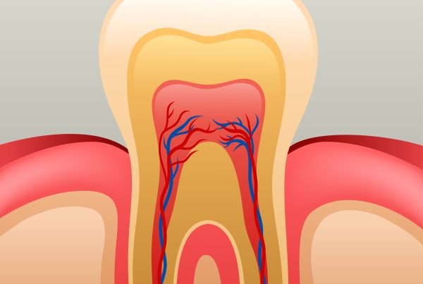 Reducing Root Canal Costs | Best Dental