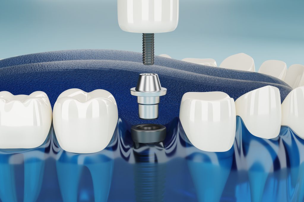 Can A Dental Implant Break? | Best Dental
