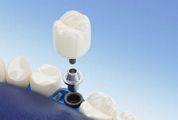 Finding The Best Dental Implant Deals | Best Dental