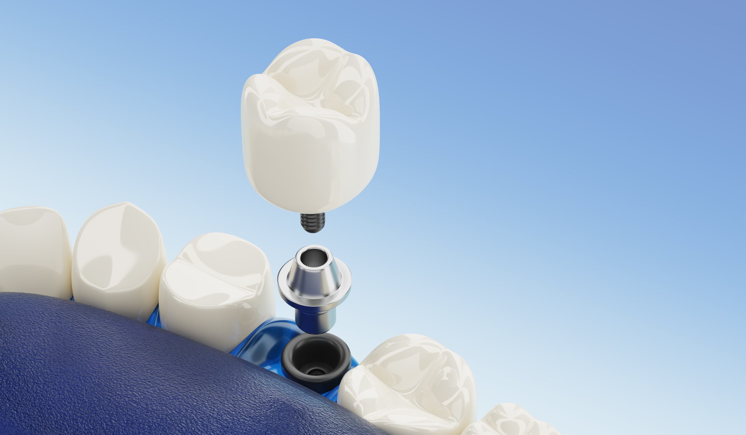 Finding The Best Dental Implant Deals | Best Dental