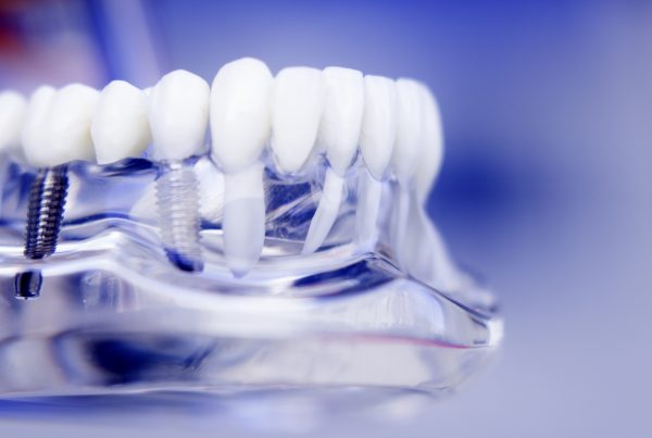 Tourism For Dental Implants | Best Dental