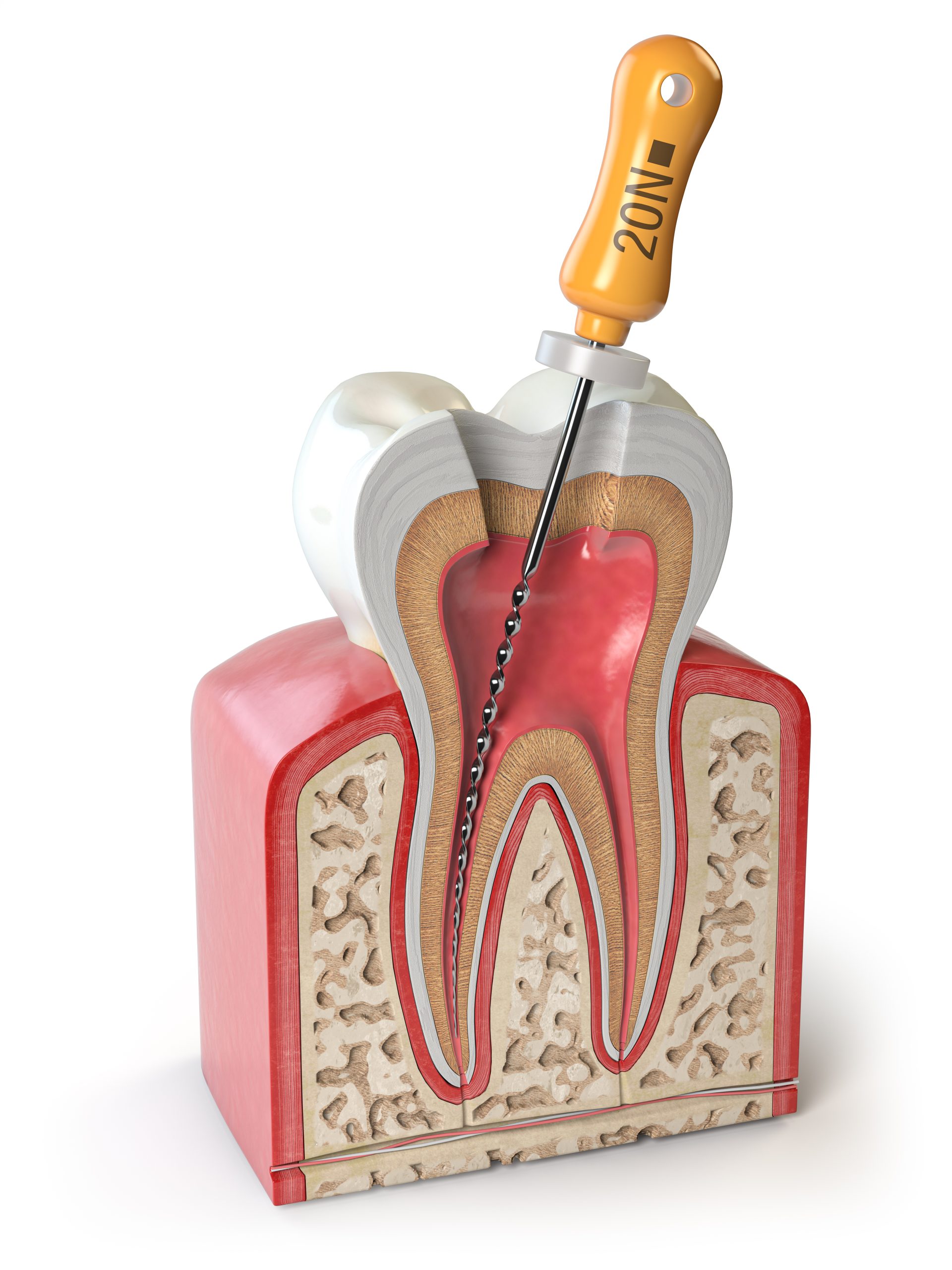 Reducing Root Canal Costs | Best Dental