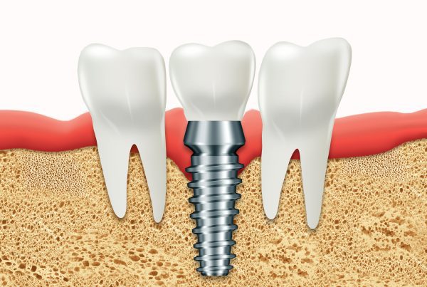 Are Dental Implants Worth It? | Best Dental