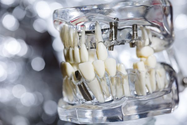 Dental Implants With Insurance Houston, TX | Best Dental