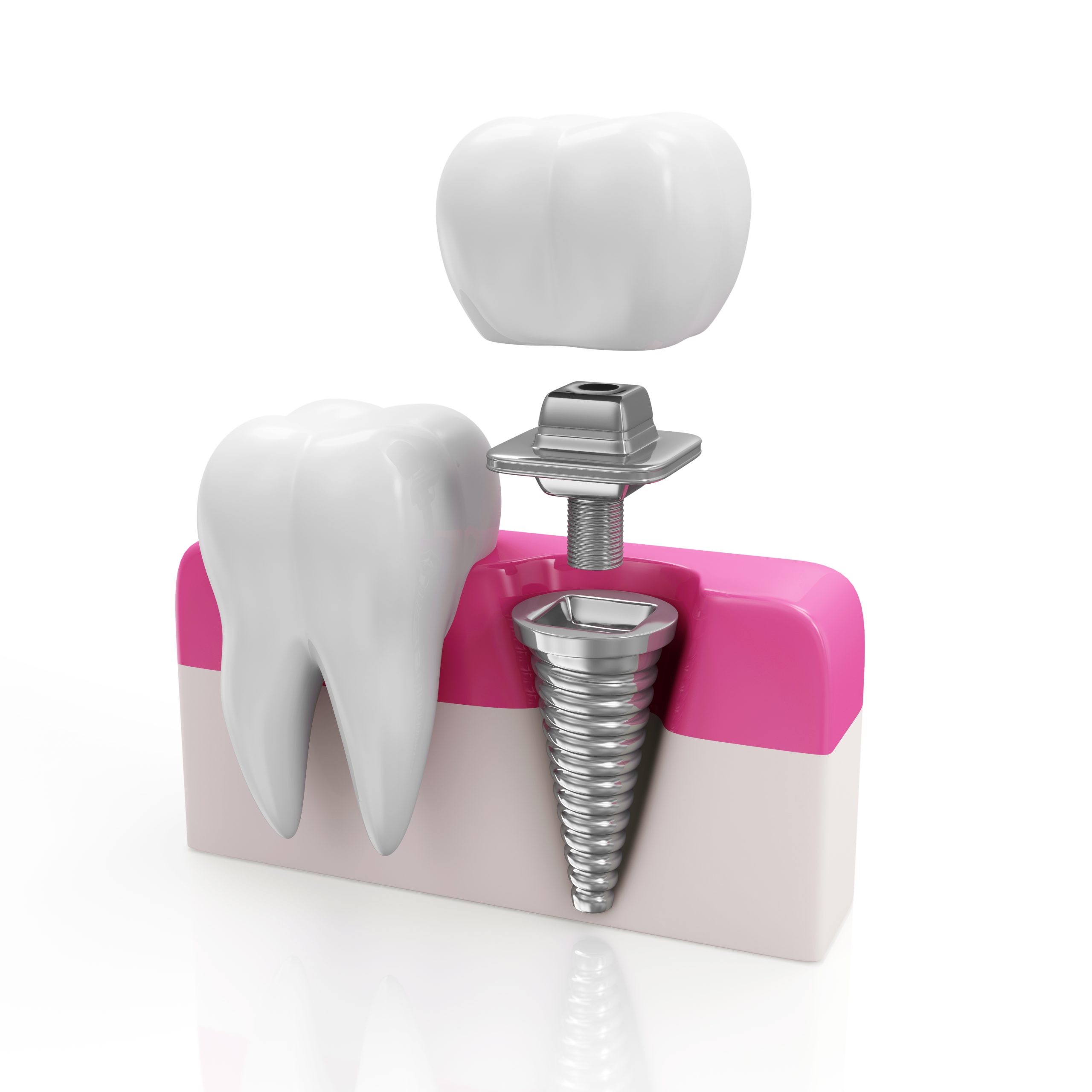 Hidden Fees Of Cheap Dental Implants | Best Dental