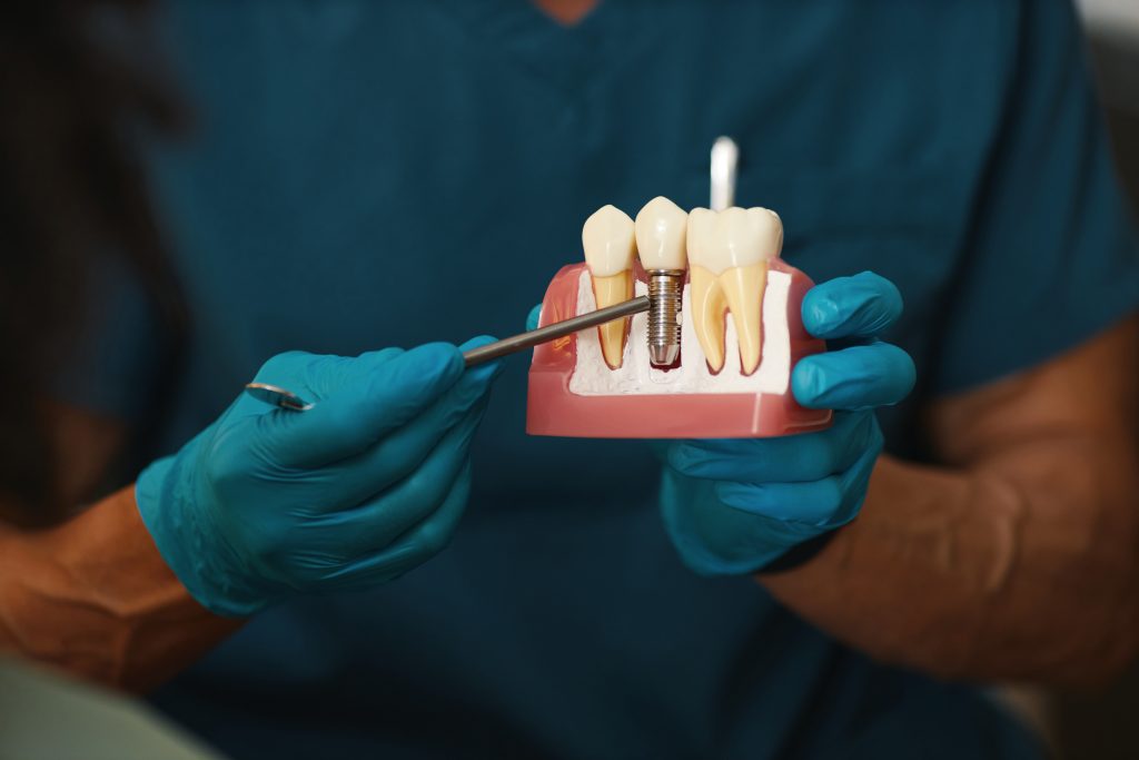 Budget Dental Implants | Best Dental