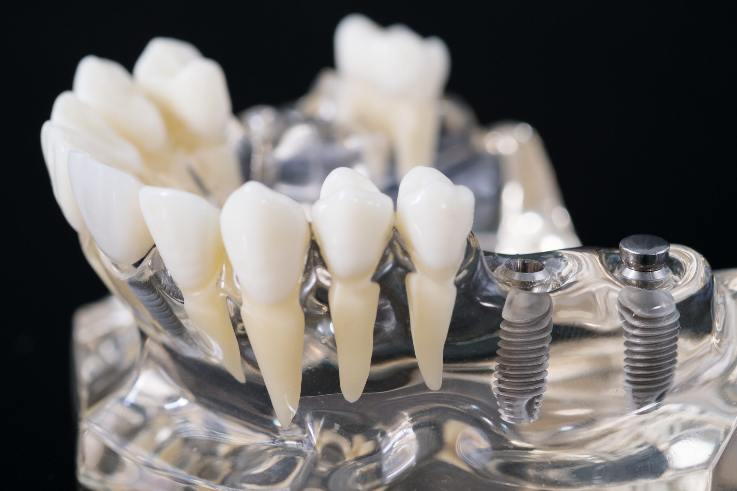 Dental Implants Aftercare | Best Dental